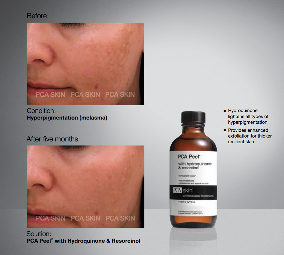 NWT PCA offers peel with hydroquinone