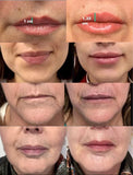 *NEW* Bacio Lips!! Purchase 4 Treatments