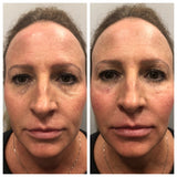 Vampire Package: (3) Vampire Facials (SkinPen Microneedling + PRP) + (1) Vampire Facelift (Filler + PRP), Plus Complimentary 90-Day Supply of Altar Vampire Skin Therapy