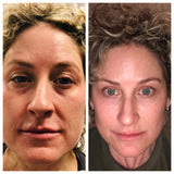 Vampire Package: (3) Vampire Facials (SkinPen Microneedling + PRP) + (1) Vampire Facelift (Filler + PRP), Plus Complimentary 90-Day Supply of Altar Vampire Skin Therapy