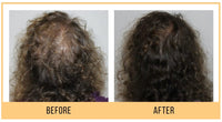 Hair Restoration Package