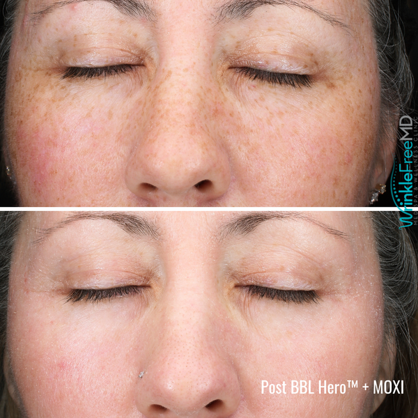 DYNAMIC DUO PACKAGE: (1)BBL HERO FULL FACE & (1) MOXI FULL FACE LASER TREATMENTS, PLUS COMPLIMENTARY ELTA MD UV STICK