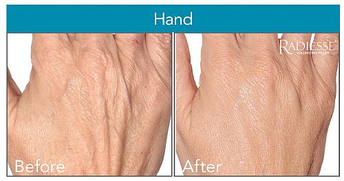 HAND REJUVENATION! TAKE 10 YRS OFF YOUR HAND FOR AN HOUR!!! Receive complimentary EltaMD Sheer Sunscreen